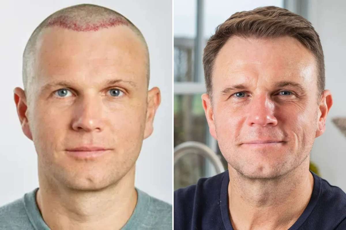 Spencer Stevenson Hair Restoration | Spexhair | The Enterprise World