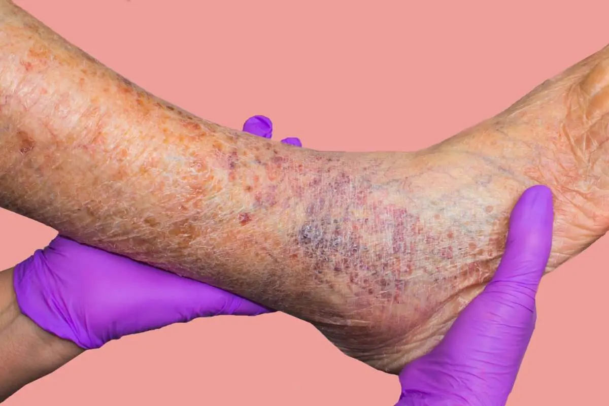 Warning Signs of Varicose Veins You Shouldn't Ignore | The Enterprise World