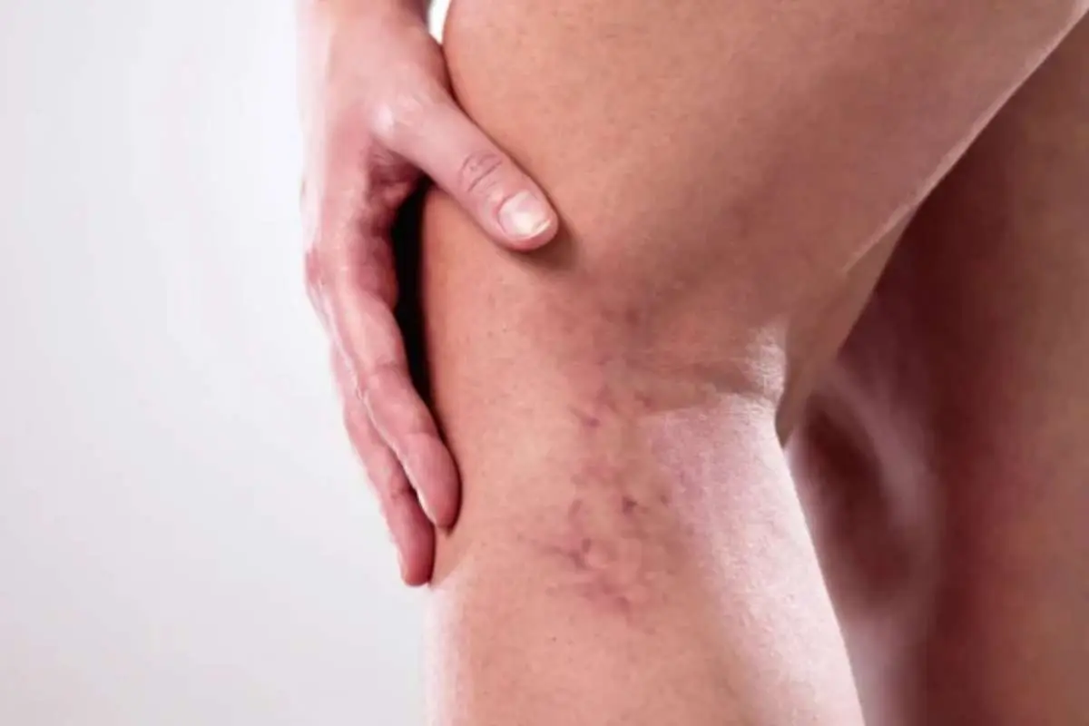 Warning Signs of Varicose Veins You Shouldn't Ignore | The Enterprise World
