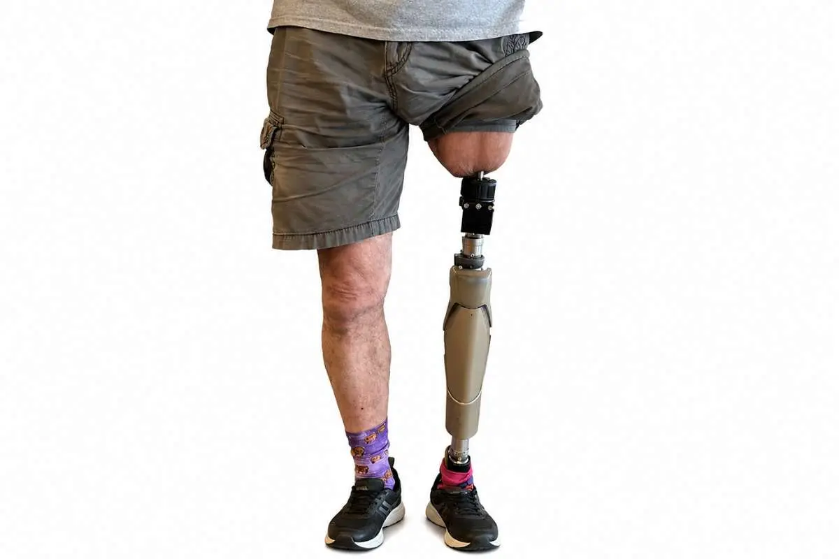 Above-Knee Amputation Recovery Timeline: What to Expect | The Enterprise World