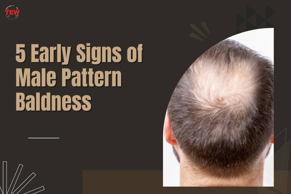 5 Early Signs of Male Pattern Baldness 
