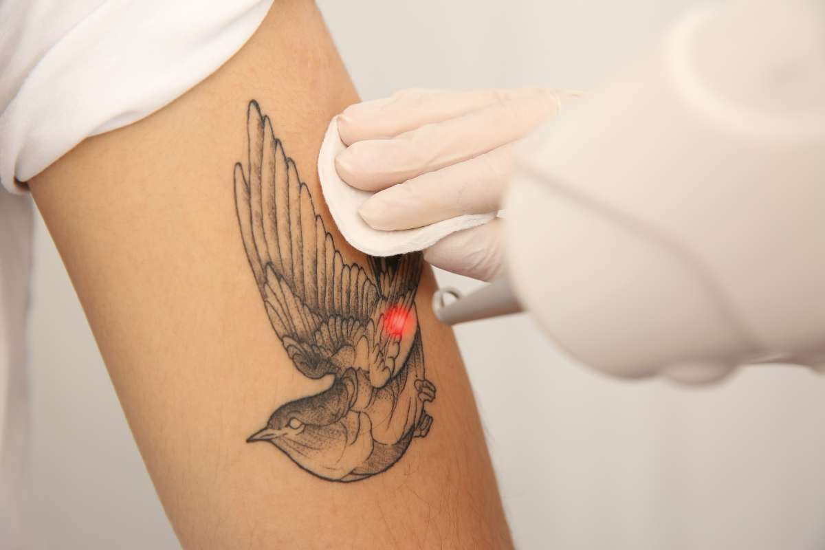 How Laser Tattoo Removal Technology Transforming? | The Enterprise World