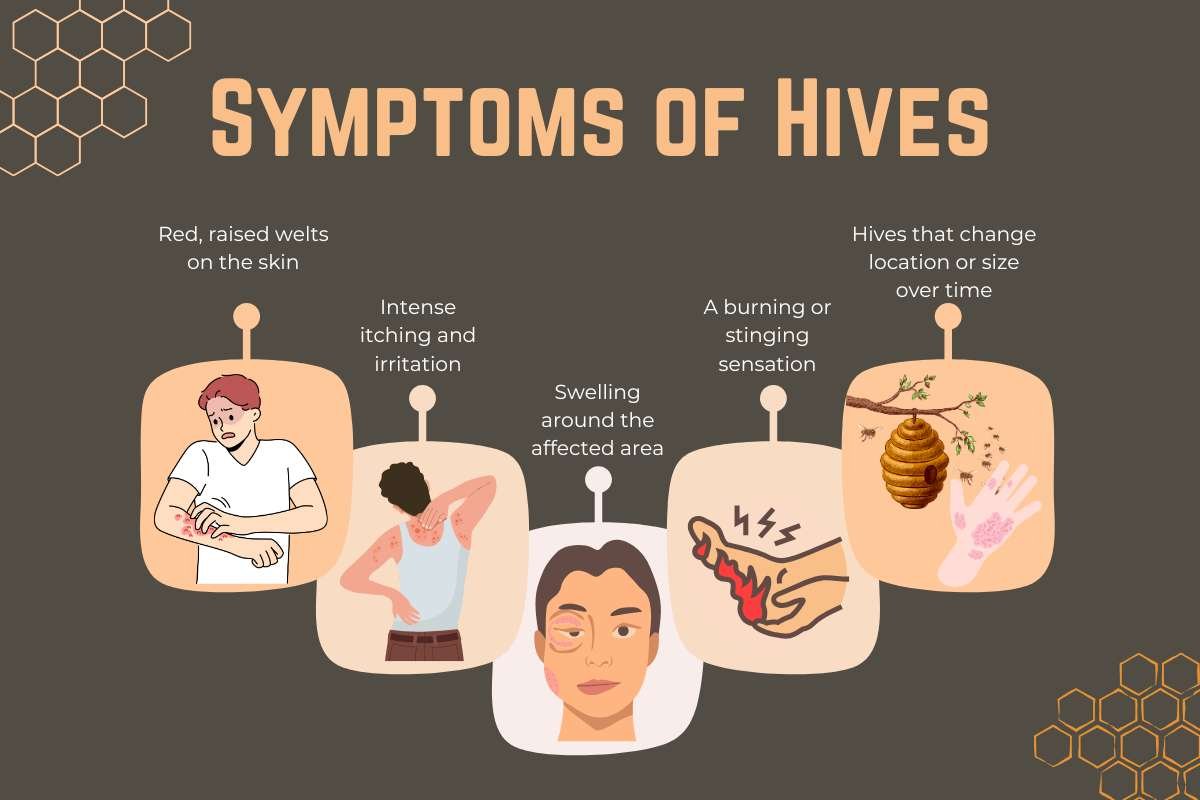 How to Cure Hives Fast? 7 Home Remedies | The Enterprise World 