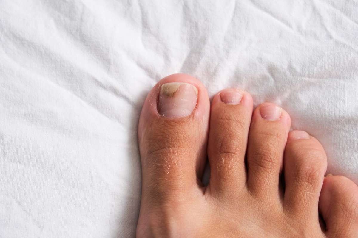 When to See a Doctor for Toenail Fungus?