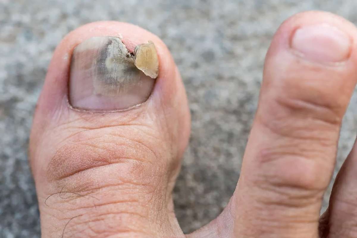 When to See a Doctor for Toenail Fungus? | The Enterprise World 