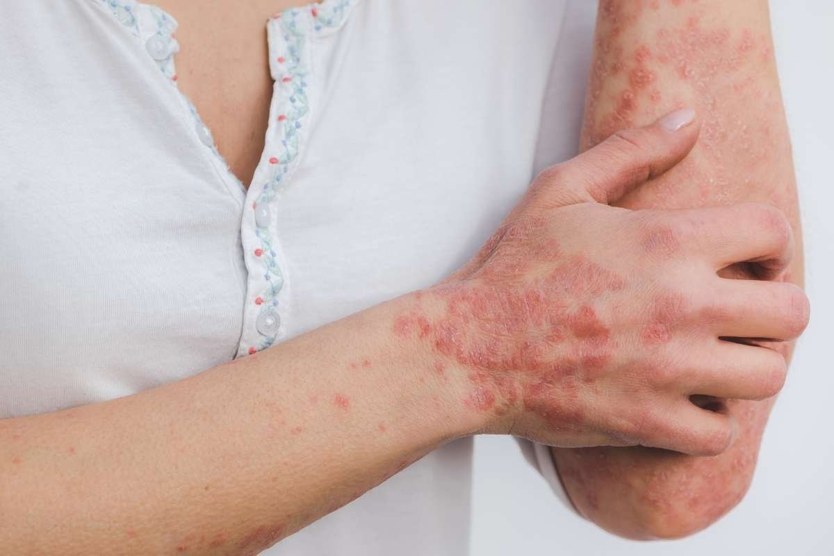 Are You Ignoring these Diseases that Cause Hives in Adults? The Overlook Could Cost You More Than an Itch 