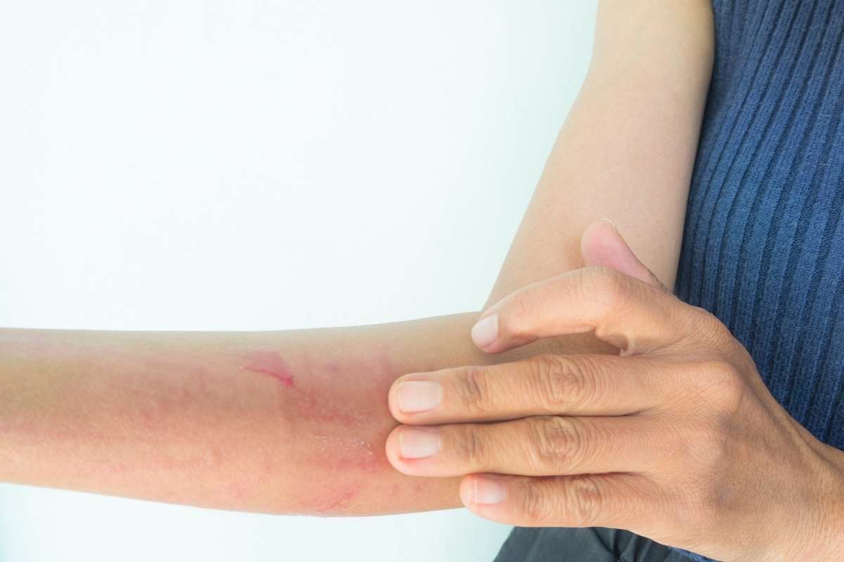 How To Manage Urticaria Effectively?