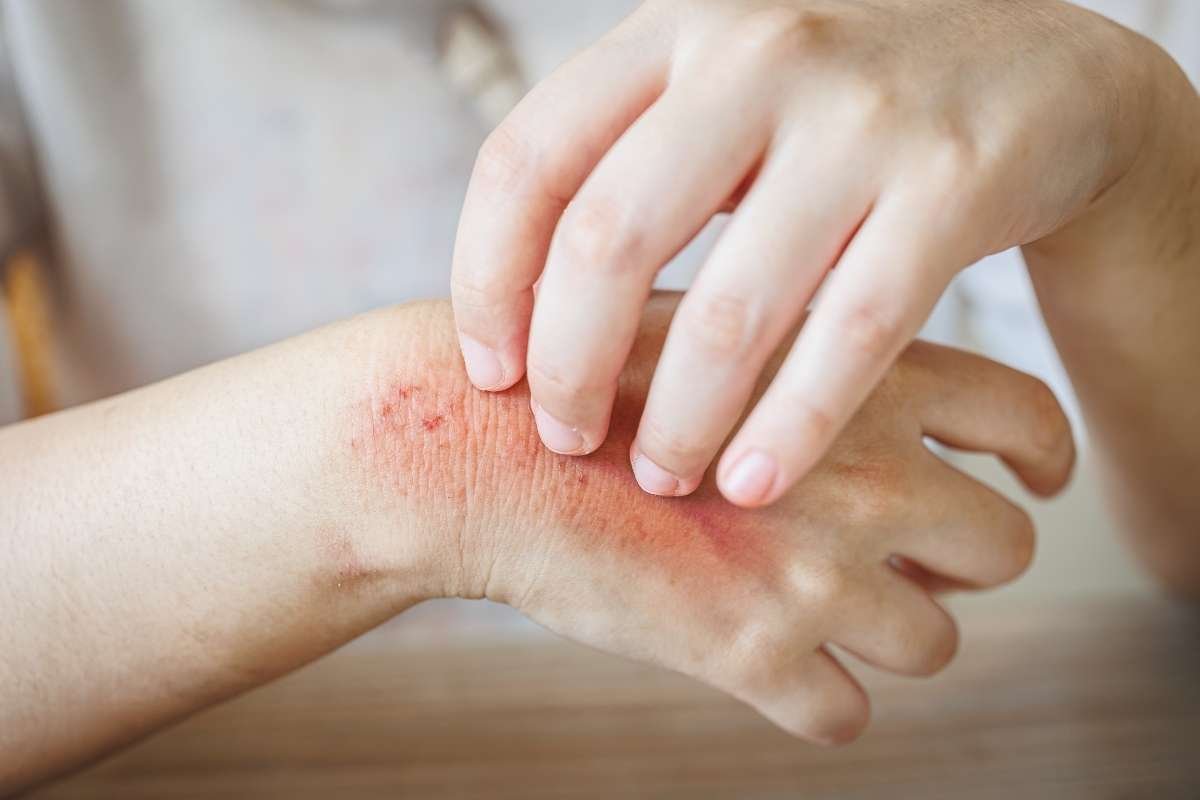 Diseases that Cause Hives in Adults- Symptoms, Factors & Treatment | The Enterprise World 