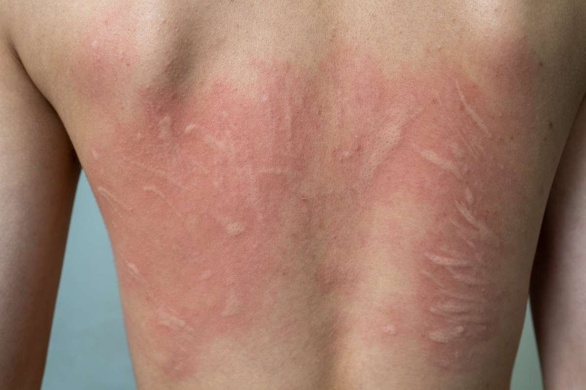 How to Cure Urticaria Permanently? Types, Symptoms & Diagnosis | The Enterprise World 