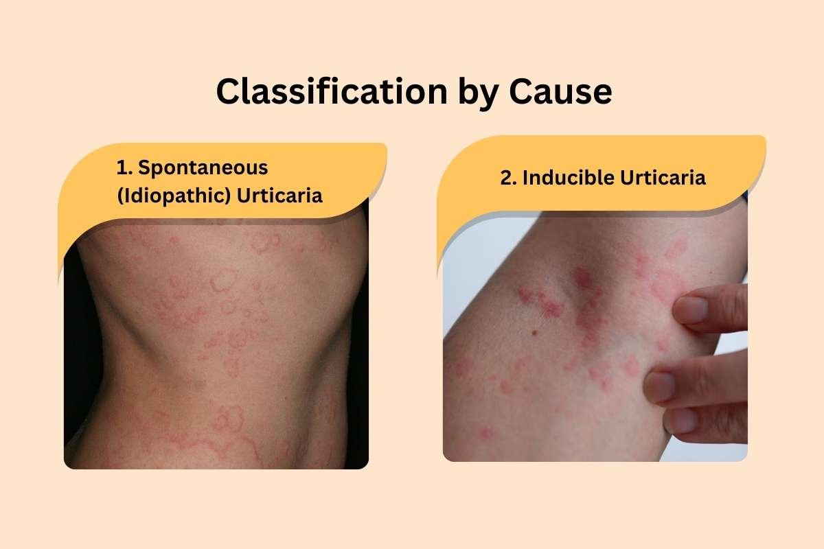 How to Cure Urticaria Permanently? Types, Symptoms & Diagnosis | The Enterprise World