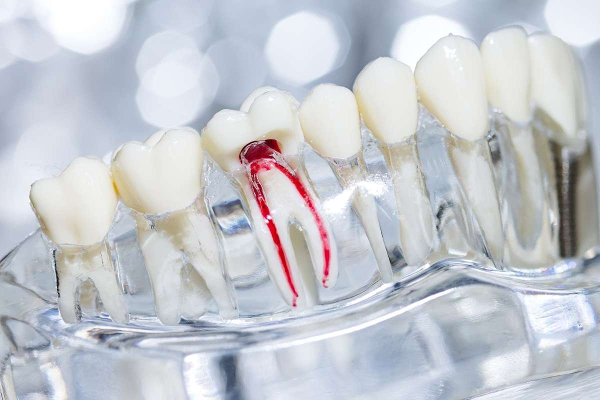 Portobello What Is a Root Canal? - Outreach | The Enterprise World