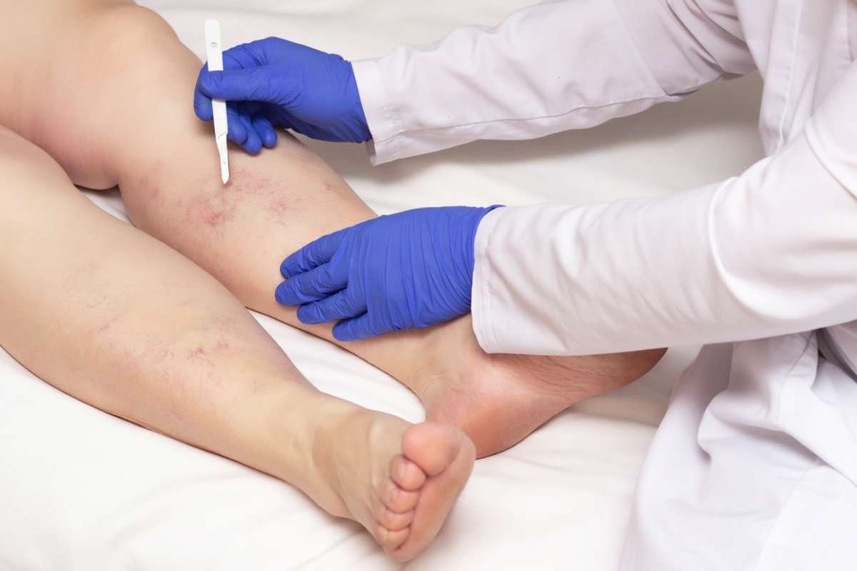 Vein Treatment Specialist in New Jersey for Modern Care | The Enterprise World
