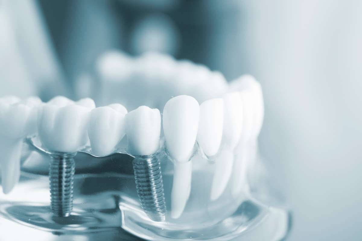 Understanding Dental Implants in Allen: Step-by-Step Guide | The Enterprise World