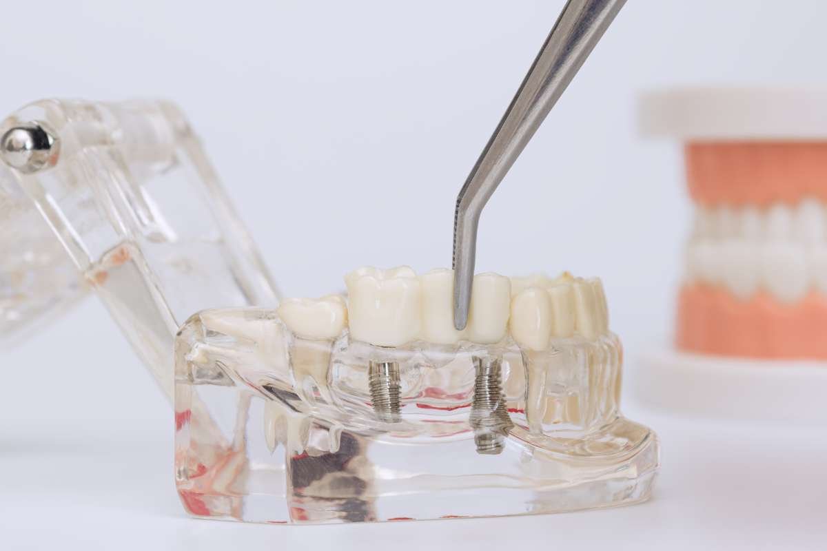 Types of Dental Implants Upper West Side NY Explained | The Enterprise World