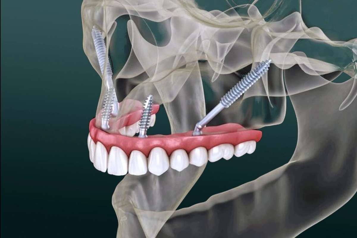 Types of Dental Implants Upper West Side NY Explained | The Enterprise World