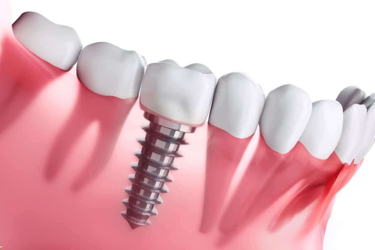 How Smoking Impacts Dental Implants in Indianapolis? | The Enterprise World 