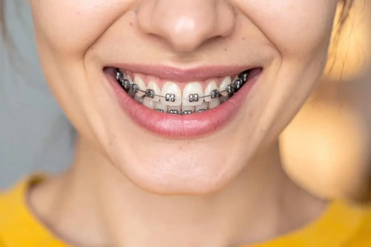 Gum Grafting Philadelphia: Restore Your Smile | The Enterprise World