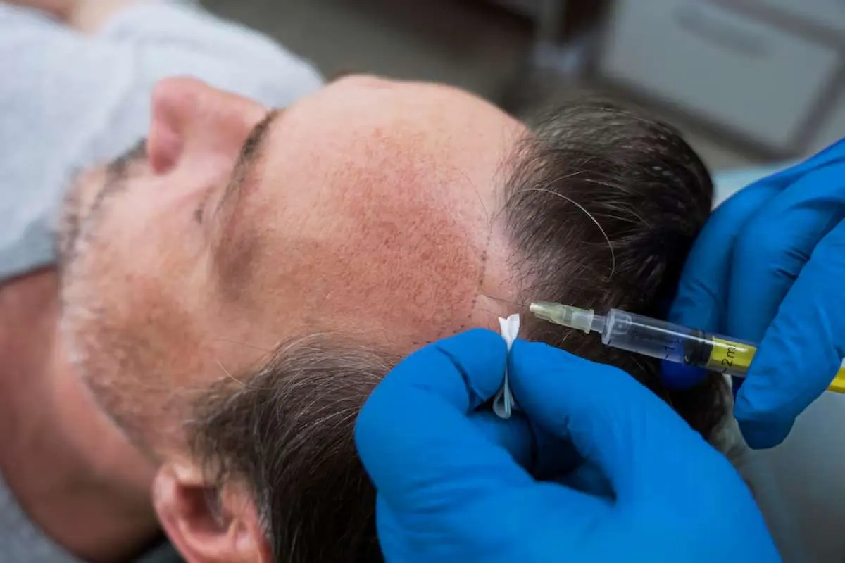 FUE Hair Transplant in Raleigh: What to Expect | The Enterprise World