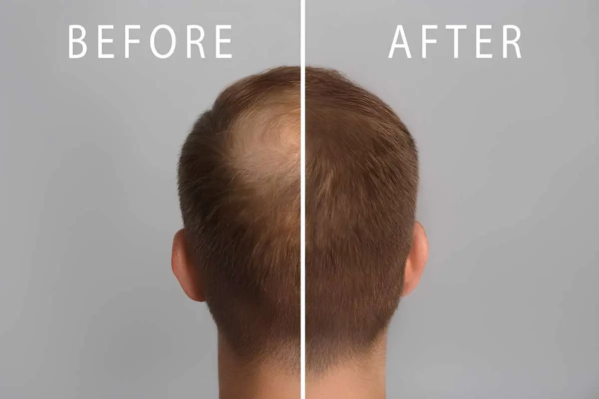 FUE Hair Transplant in Raleigh: What to Expect | The Enterprise World